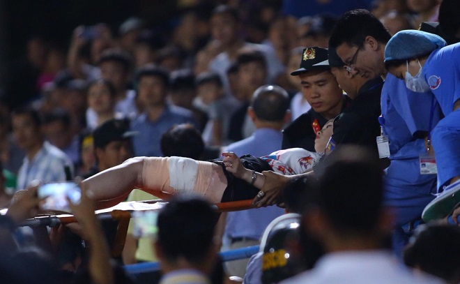 Nữ CĐV phải mổ 2 lần v&igrave; d&iacute;nh phải ph&aacute;o s&aacute;ng từ CĐV Nam Định