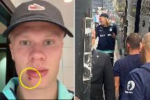 Erling Haaland kh&acirc;u ba mũi sau tai nạn hy hữu với xe bus